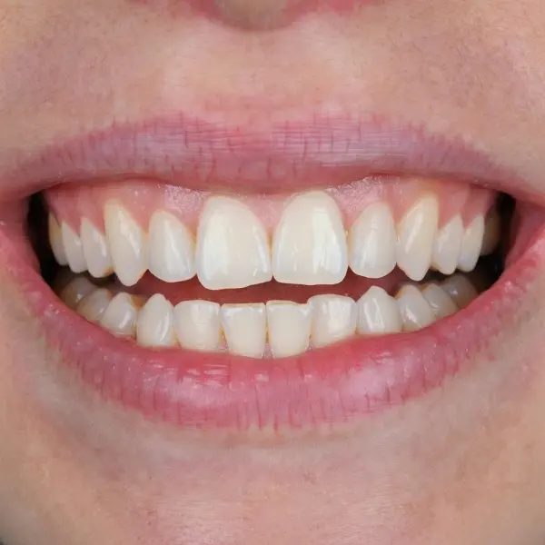After whitening — bright white teeth