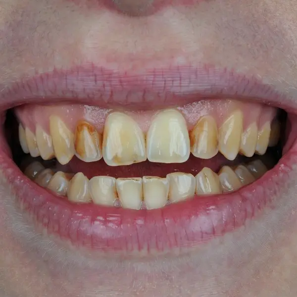 Before whitening — yellow teeth