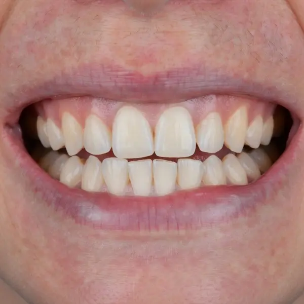 After whitening — bright white teeth