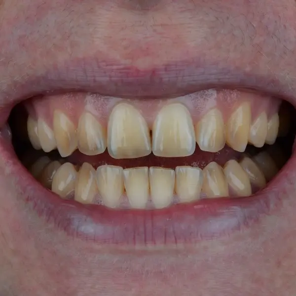 Before whitening — yellow teeth