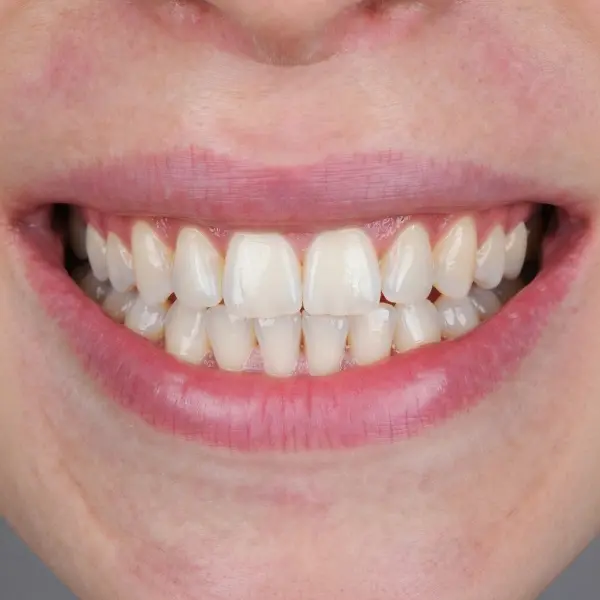 After whitening — bright white teeth