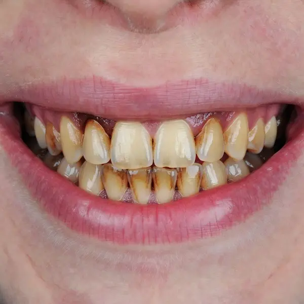 Before whitening — yellow teeth